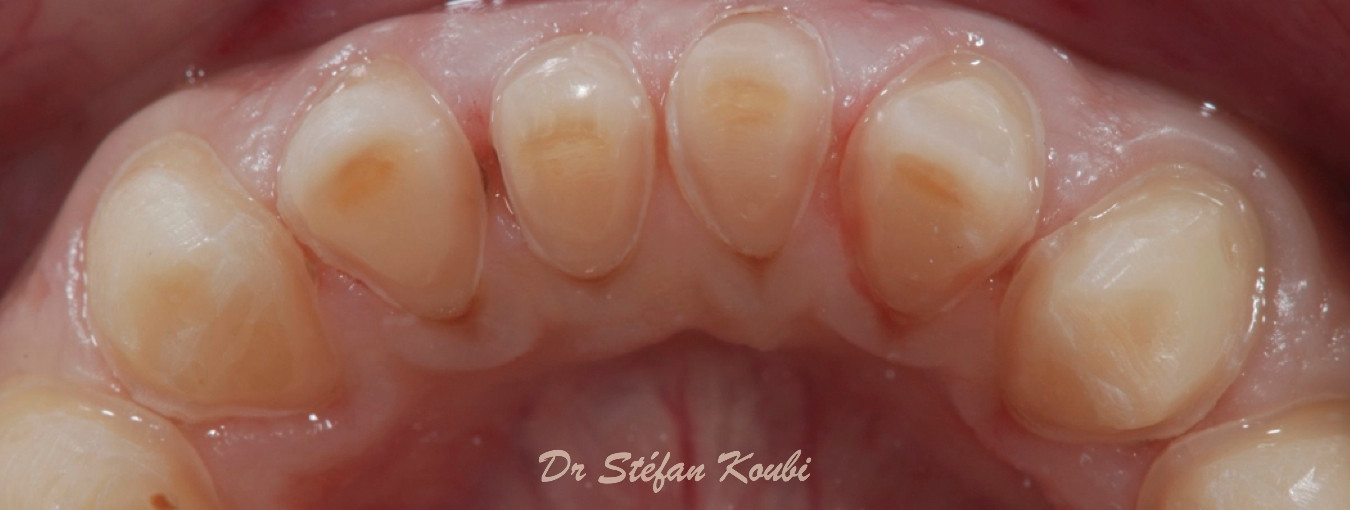 veneers and crowns/ Dr Stéfan Koubi